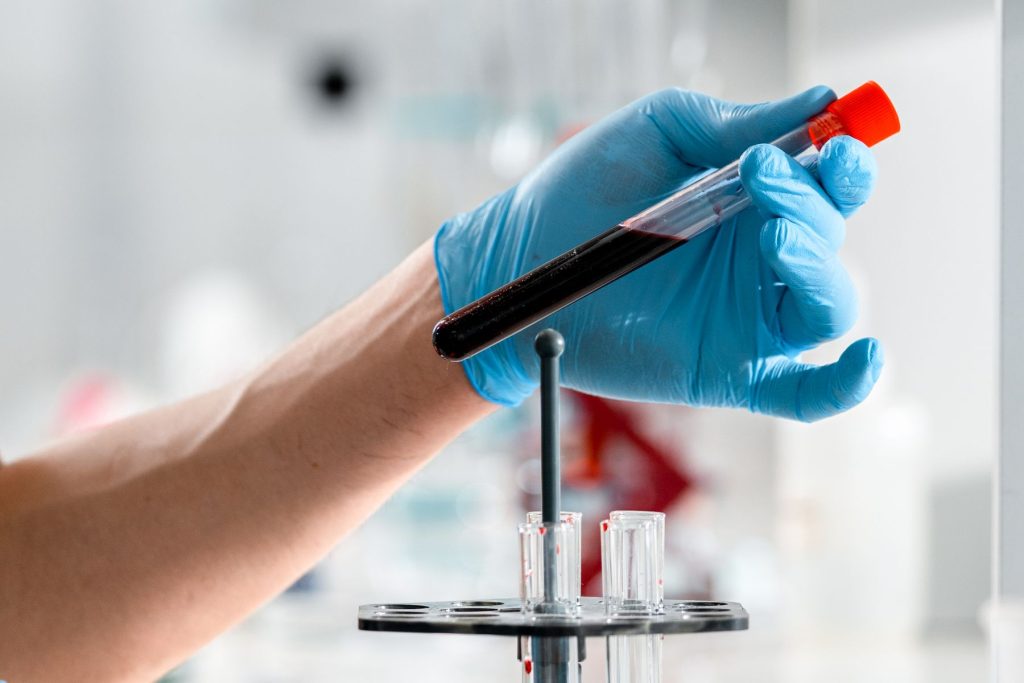 Blutprobe im Labor – verschwiegene HIV- und Hepatitis-Infektion als Grund für eine Härtefallscheidung